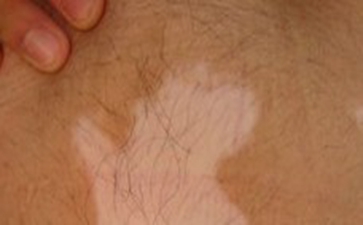 白癜风有哪些诱因 白癜风有哪些诱因