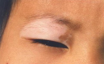 白癜风有哪些诱发原因 白癜风有哪些诱发原因