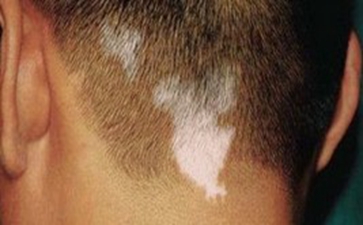 确诊白癜风的步骤是什么呢 确诊白癜风的步骤是什么呢