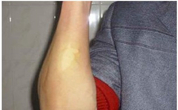 致使青少年白癜风的原因有哪些 致使青少年白癜风的原因有哪些