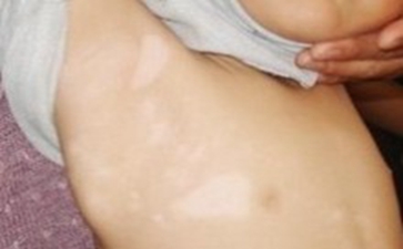 怎样分辨白癜风 怎样分辨白癜风