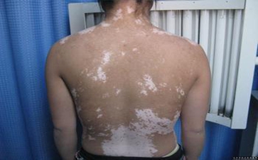 医治白癜风的办法都有啥 医治白癜风的办法都有啥