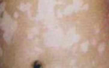 医治白癜风的办法都有哪些 医治白癜风的办法都有哪些