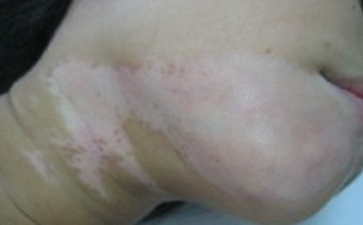 白癜风的症状是哪些 白癜风的症状是哪些